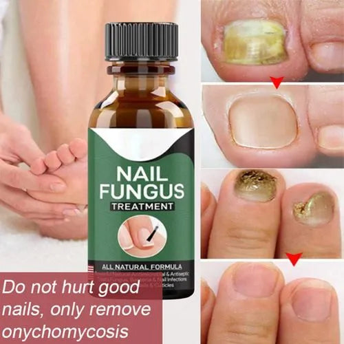 Nail Fungas Repair Serum